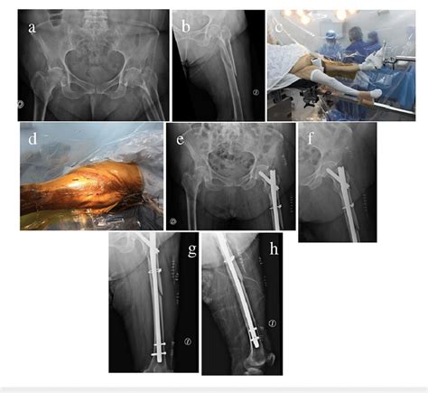 Left Subtrochanteric Fracture And Well Leg Scissor Position A And B A