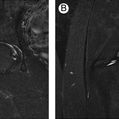 (PDF) Femoral Neck Stress Fractures