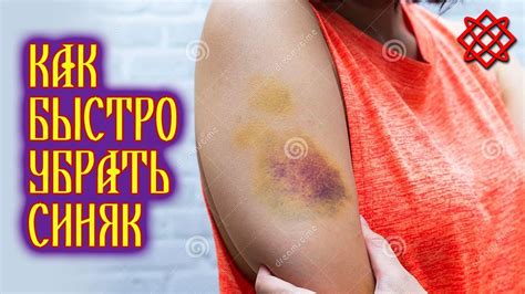 КАК ИЗБАВИТЬСЯ ОТ СИНЯКОВ И ГЕМАТОМ. Народные Средства от Синяков - YouTube