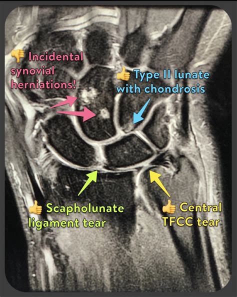 Wrist Ligaments Mri