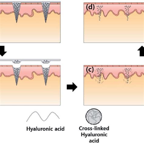 Pdf Microneedles Containing Cross Linked Hyaluronic Acid Particulates