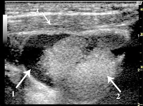 Floor Of Mouth Cyst Usg Viewfloor Co