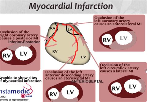 Cardio 44 Ischemic Heart Disease Flashcards Quizlet