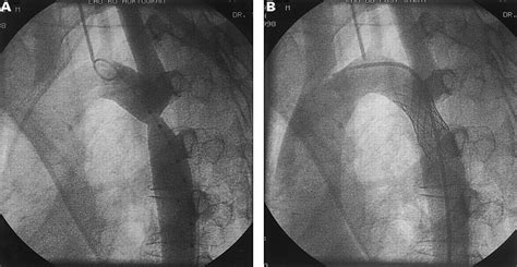 Stent Implantation For Aortic Coarctation And Recoarctation Heart