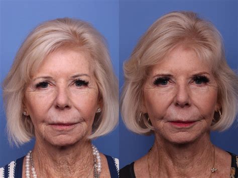 Facelift Before And After Pictures Case 419 Scottsdale And Phoenix Az