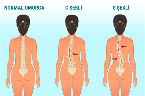 Skolyoz Nedir Tedavisi ve Ameliyatı Nasıldır Turan Turan