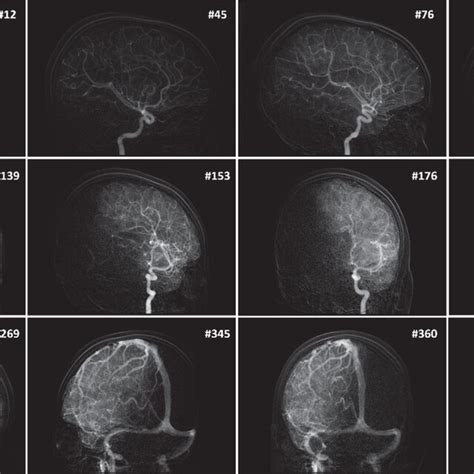 Representative Frames From Contrast Enhanced Bone Free Raw Data