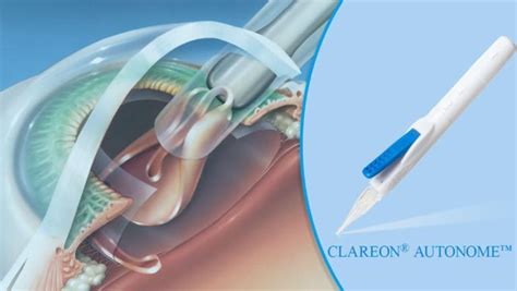 Nieuwste Implantlens Clareon® Autonome™ Retina Total Eye Care