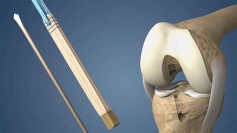 Torn Acl Reconstruction Quadriceps Graft Understandortho™