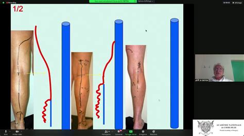 Place De La Chirurgie Dans Le Traitement Des Varices Actualisation De