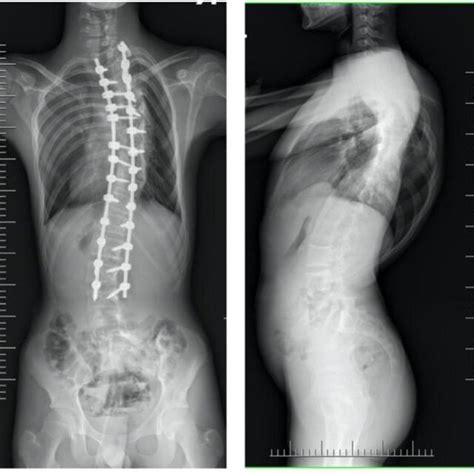 Radiographs of a 17-year-old patient with a severe spinal deformity ...