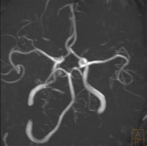 Spontaneous Subclavian Artery Dissection Causing Ischemia Of The