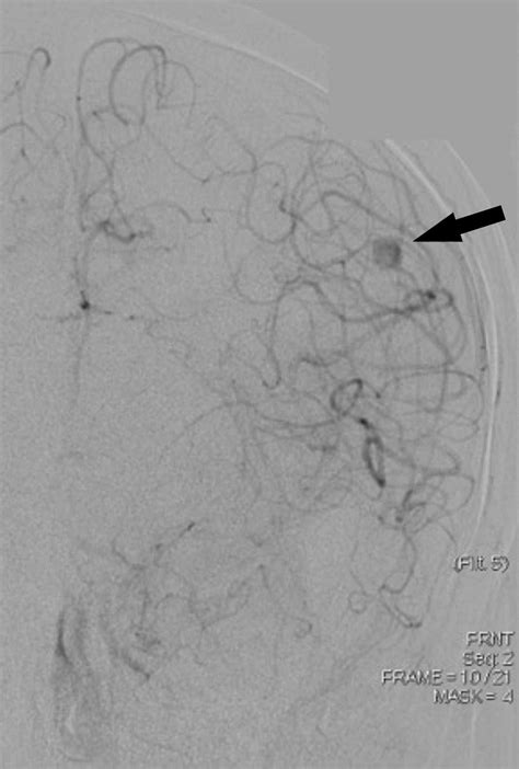 Pre Embolization Digital Subtraction Angiography Image Obtained Upon