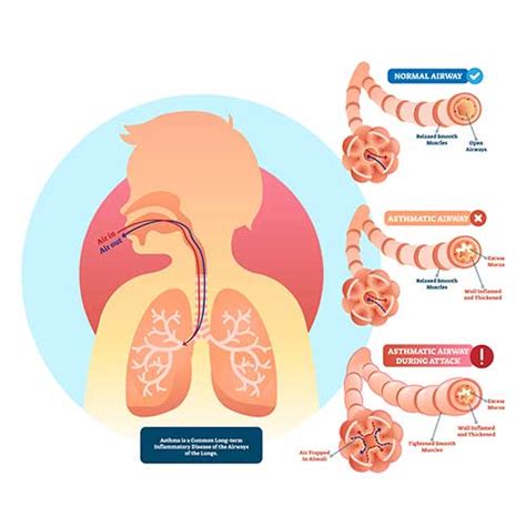 Asthma - Symptoms, Causes and Treatment of Asthma