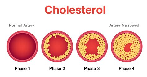 Cholesterol Levels And Triglycerides at Erma Thomas blog