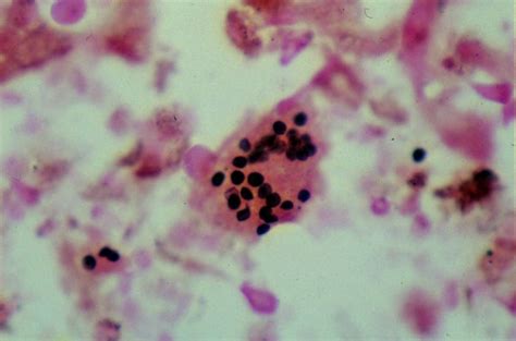 Pneumocystis Carini In Special Silver Stain Medical Laboratories