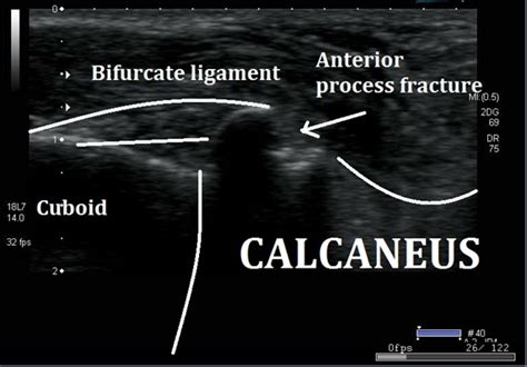 Anterior Calcaneus Fracture