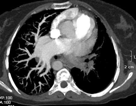 Unilateral Pulmonary Artery Atresia Image Radiopaedia Org