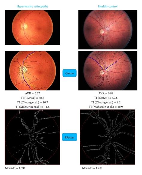 Hypertensive Retinopathy Grade 1