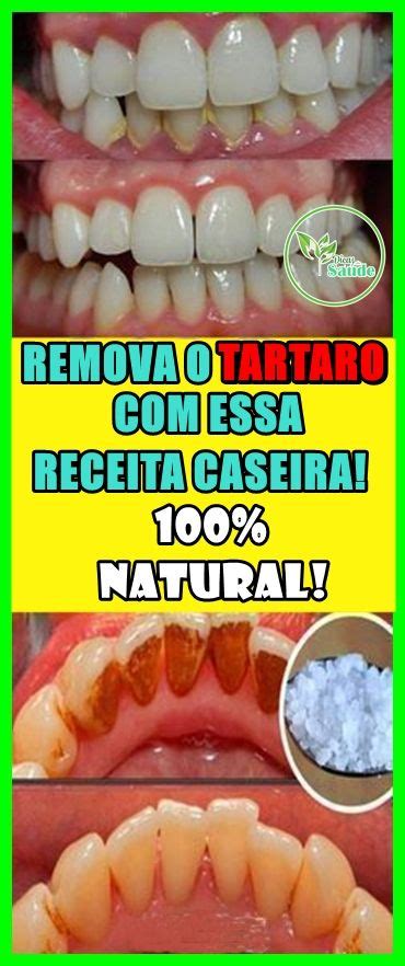 Receita Caseira Para Remover A Placa Bacteriana E O T Rtaro Dos Dentes