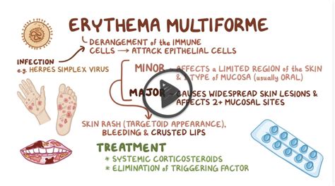 Erythema Multiforme Reeldx Smarty Pance