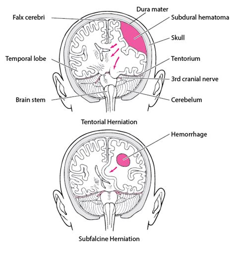 Tonsillar Herniation