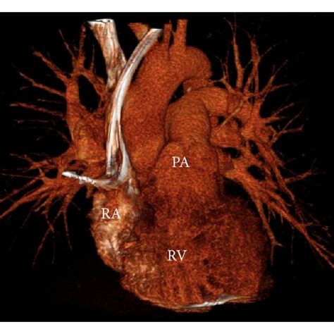 A Postimplant Anteroposterior Chest Radiography Showing The Atrial