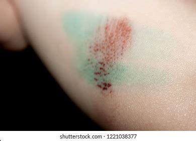 Infection Or Abrasion Of The Skin Images, Stock Photos & Vectors ...