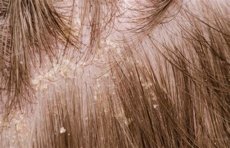 Dandruff vs. Dry Scalp: What's the Difference - Lifestyle and Hobby