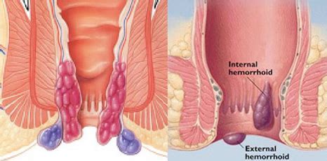 Basur Hemoroid Hastalığı Nedir Tedavisi ibrahimfirat net KişiseL