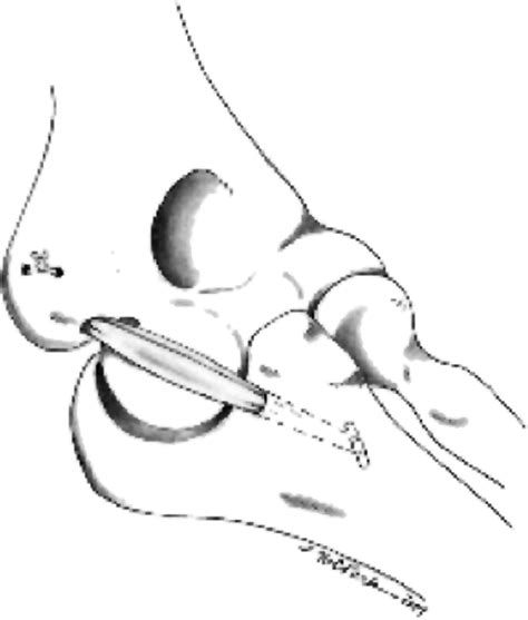 Elbow Medial Ulnar Collateral Ligament Reconstruction Clinical Relevance And The Docking