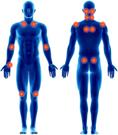 Fibromyalgie Diagnose Fibromyalgie