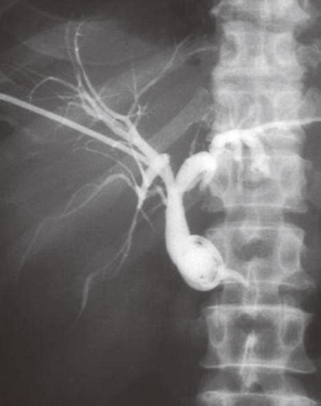 Interventional Radiology In The Management Of Malignant Biliary Obstruction