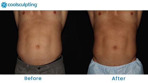 Coolsculpting Before and After Pictures - Male Flanks