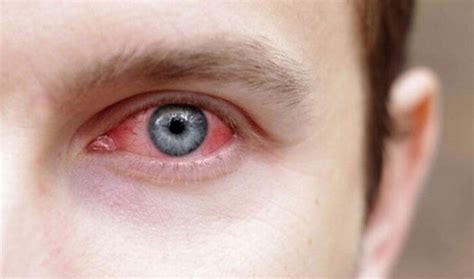 Как выбирать глазные капли, которые помогут от боли и рези? - Подглазами.ру