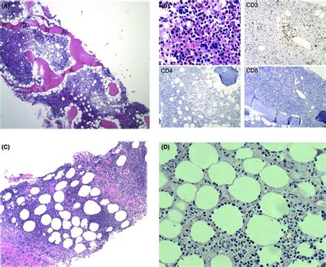 A Bone Marrow Low Power B Bone Marrow High Power Hypercellular