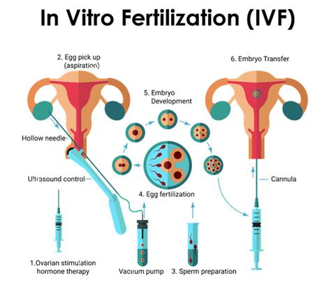 Ivf In Vitro Fertilisation Process Dr Suparna Banerjee