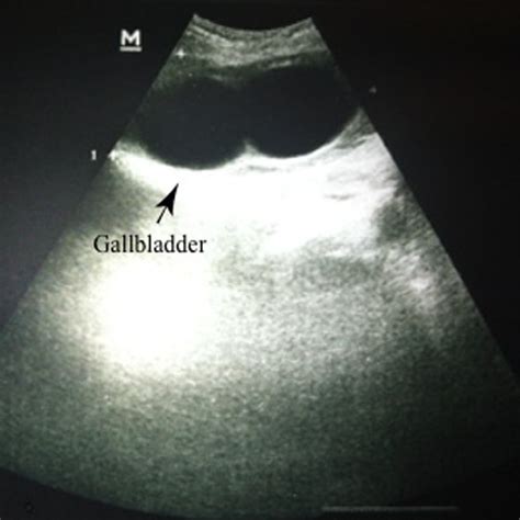 [pdf] A Rare Etiology Of Acute Abdomen Syndrome Gallbladder Torsion