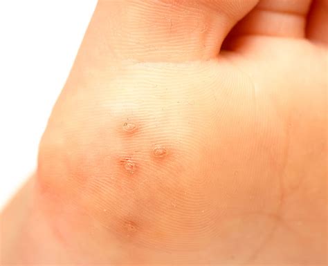 Warts How To Identify Causes Types Treatment And Prevention