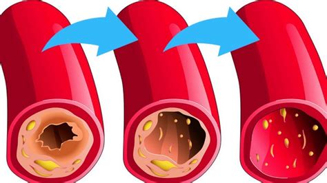 These 8 Foods That Unclog Arteries Naturally And Protect Against Heart