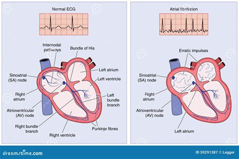 Atrial Fibrillation Heart Diagram