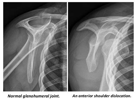 Shoulder Dislocation X Ray