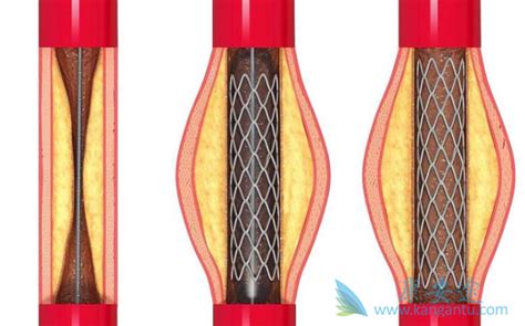 心脏支架手术后寿命是延长了还是减少了？ 康安途海外医疗