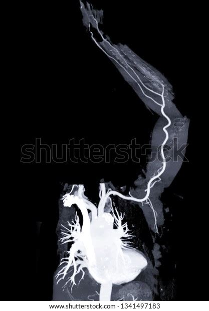 Cta Left Brachial Artery Ct Scan Stock Illustration 1341497183