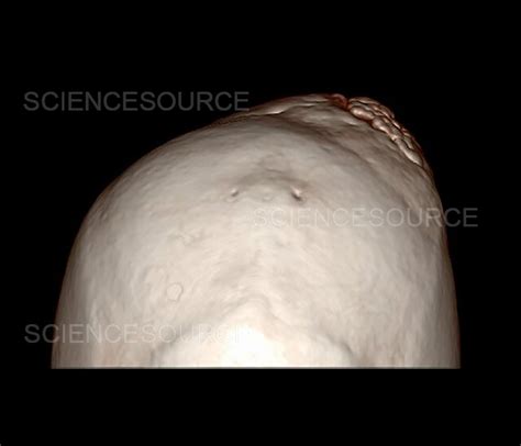 Meningioma And Bony Hyperostosis Ct Stock Image Science Source Images