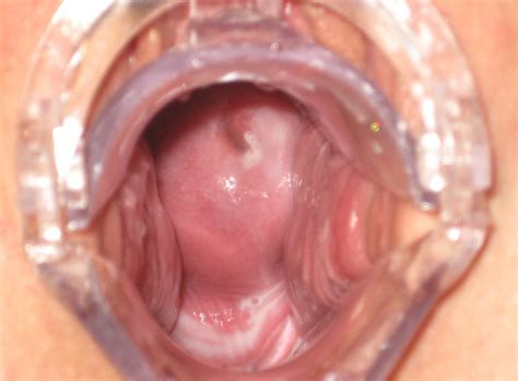 Angel Anna Set 226 Speculum 226 62 Porn Pic