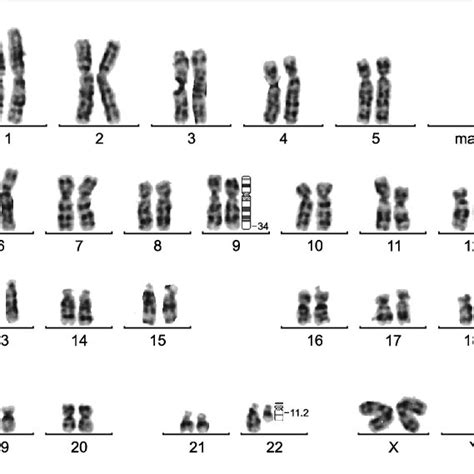 Representative FISH signal patterns using LSI BCR/ABL dual color dual ...