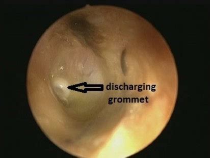 discharging ear  treatment care