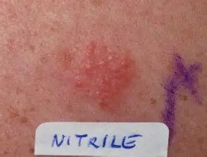 Dermatite De Contato Por Nitrilo Hoogstra Centros M Dicos