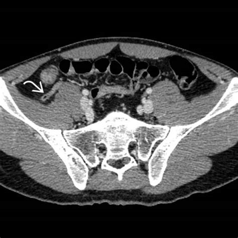 Mesenteric Adenitis And Enteritis Clinical Gate